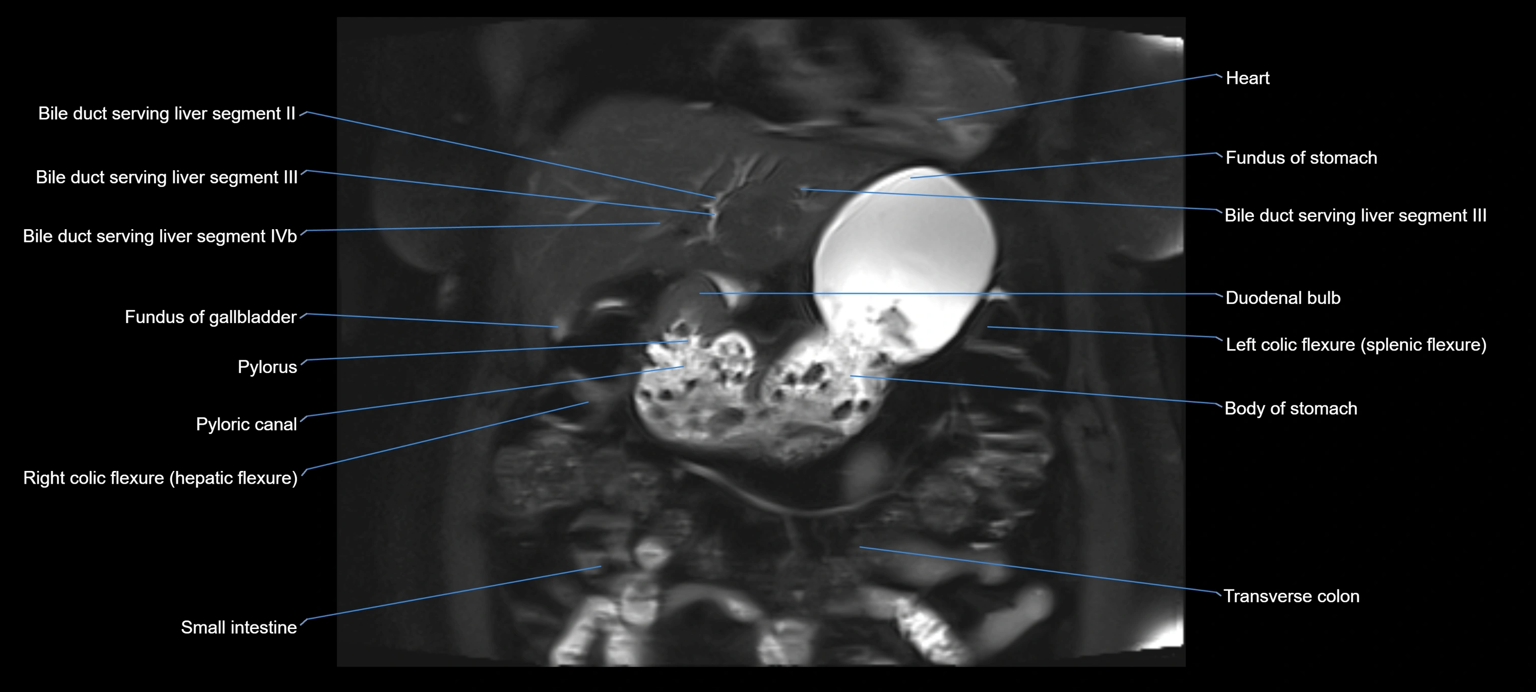 MRI MRCP coronal cross sectional 3T radiology  image-img-00001-00005.webp